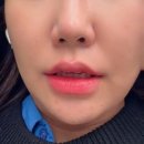 청담맥의원 | [관리] 구로 청담맥의원 아쿠아필, 여드름 주사 후기 / 미간, 턱보톡스 후기(유지기간/가격/효과)