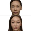 일치성형외과의원 | 40대 이마거상 수술 2년 후기 (거상경력 20년차 원장)