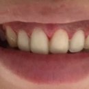 스마일치과 | 무삭제라미네이트&amp;잇몸성형,거미스마일 , 서울치과 리얼 후기