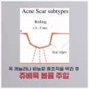 여드름흉터 쥬베룩볼륨 도트필 피코프락셀 효과 후기 by. 닥터지니 강남역선릉역압구정로데오역피부과