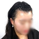 헤어후 | 여자 두피문신 후 M자 헤어라인 정수리 후기 인터뷰