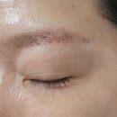 사랑빌 | 광주 ' 오월눈썹 ' 붉은 눈썹, 회색 눈썹 레이저 잔흔제거 2차 후기(ft.내돈내산)