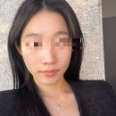한사랑한의원 일산 태반주사 자하거 약침 후기, 효과, 전후비교, 간격