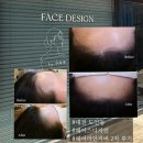 도안북로 | 대전 도안동 페이스디자인 내돈내산 헤어라인커버 2차 리얼후기