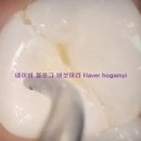 우두정거장 | 임플란트 수술하고 3일째, 40대 임플란트 수술 후기....(뼈이식 안함)