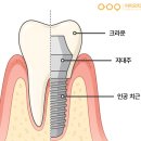 아이오치과의원 | 선운2지구치과 임플란트 골유착, 왜 기다려야 할까요?