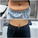 엘다라인 | 뱃살 다이어트 튠바디 + 복부지방분해주사 효과 2회차 후기