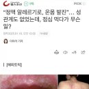 &#34;정액 알레르기로, 온몸 발진&#34;...점심 먹다가 무슨 일? 이미지