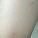 오금우리내과의원 | 알레르기 두드러기 2주차 :: 얼굴 전신 번짐 | 전신 다형홍반 | 아낙필락쇼크 알러지와 두드러기 대절정...