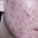 크림약국 | 아젤리아 크림 약국 여드름 연고 내돈내산 후기