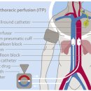 동맥내 항암치료 (Intra-Arterial Chemotherapy)의 기대 효과 이미지