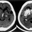 고혈압성 뇌출혈[hypertensive intracerebral hemorrhage] 이미지