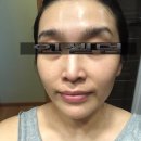 인셀덤 day | (주)리만, 인셀덤 화장품 사용 솔직 후기 @ 성형화장품으로 인정!!