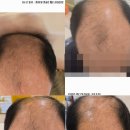 남자 탈모관리 6일 후기｜오렌지브로우 두피관리 앰플 케어 비포에프터