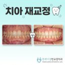 UR(상주시)-[왕산로]-상-5 | 치아 재교정 해야하는 케이스와 앞니재교정 비용 전후 후기