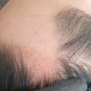 씨유동탄M메디컬 | 동탄탈모] M자 탈모, 7개월 만에 이렇게 달라졌습니다.[실제 치료 후기] 아이엠유의원 탈모클리닉