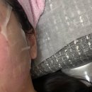 수원 편평사마귀 관리 후기 여름 맞이 얼굴 요철 정리