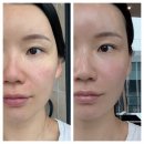 타이탄 | 신사역 피부과 중안부 리프팅 이브타이탄 리얼후기