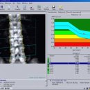 BMD(골다공증 검사) 이미지