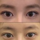 팝성형외과 | 10년이 지나 풀려버린 눈,,눈재수술 쌍수 팝성형외과 상담 후기