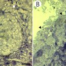 상피성 X-cell psuedotumor의 thin section. 이미지