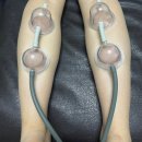 청담힐의원 | 청담 피부과 :: 여름 준비 종아리 보톡스 하이힐주사 후기 청담힐의원