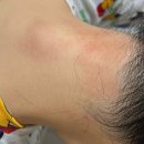 피부 건선 천연라이브 청대밤 스틱 연고 내돈내산 솔직 후기