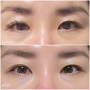 가락동피부과, 눈밑지방재배치 레이저 통증,멍 후기(온오프피부과)