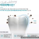 고읍미소치과의원 | &lt;전주자인치과 전문가 미백후기&gt;- 자연스럽고 시림없는 톤업으로 자신감 있는 미소를 만나보세요