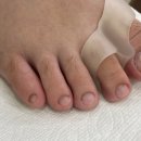 레푸스인하대역점 내성발톱 무좀발톱 발각질 문제성발 이미지