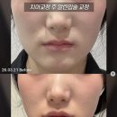 봄눈피우다의원 | 치아교정했는데 왜 더 늙어 보일까? 입술말림증 원인과 해결 방법