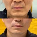 채피부과의원 | 대구동성로피부과추천 실리프팅 내돈내산 후기