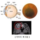 맥락막 흑색종(Choroidal melanoma) 눈 질환이란? 이미지