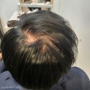다모아헤어크리닉 | 의정부가발 고민 끝! 노원역 리디아153노원점에서 30대 정수리부분가발로 자신감을 되찾았습니다