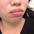 아인 메디칼 | 인천 입술라인 커버 전문 입술반영구화장 아인뷰티랩인천