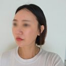 강남피부과 미글로우 리프팅 | 2세대 마이크로웨이브로 불독살 라인관리 한 솔직후기 💕