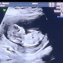 시험관실패 후 자연임신 과정 후기(한약,항인지질항체,크녹산,골프여행,증상)