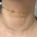 목 통 (2) (옥내1) | 청담공의원(공클리닉), 디어넥주사 선천적 목주름주사 내돈내산 리얼후기 2회차