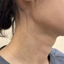 트로피피부과의원 | 압구정 트로피피부과 쥬브아셀 시술 후기, 마크뷰로 본 모공·주름 변화(1,2개월 후 경과)