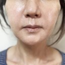 잼버실리프팅 부작용 없이 엄마 얼굴라인 시술해 드린 후기