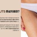양재역 튼살피부과 튼살없애는법 100% 복원이라는 말에 속지마세요