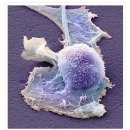 육종암의 종류 이미지