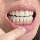 다인어린이집 | 양치를 그렇게 열심히 했는데 잇몸이 내려앉았다니? 노르다인 4개월 후기