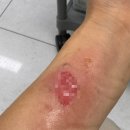 푸른자동차병원 | 심재성화상2도, 대구 푸른화상병원 후기, 타박상 화상병원, 어린이 흉터