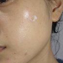 숙지 | 디페린겔 효과, 사용후기 꼭 숙지해야하는 사용법까지