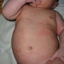 [자가면역질환 시리즈:아토피 피부염]2.유.소아,성인 아토피와 면역계의 특징 이미지