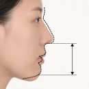 필치과의원 | 앞니 마모, 앞니 마모 심해서 합죽이 입으로 보인 케이스, 크라운 치료로 자연스럽게 해결! [공덕 치과]
