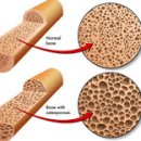 골다공증 수치 | 정상수치는? 이미지