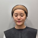 예진푸드 | 압구정로데오역 청담피부과 엘란쎄 내돈내산 전후 효과 후기