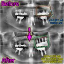 미추홀치과의원 | 상악동 거상술 즉시 임플란트의 뼈이식 과정과 비용 및 통증과 후기는?(주안동 치과)